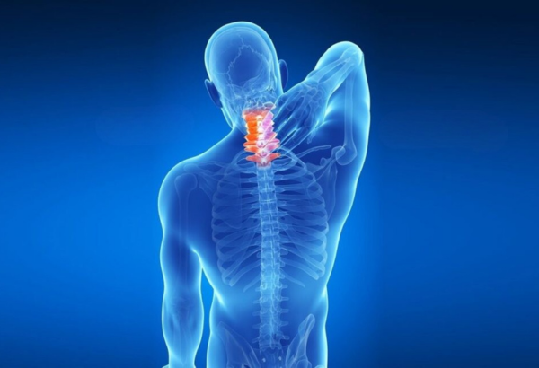 Cervical Spondylosis